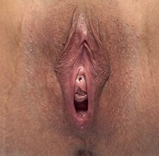 Vaginoplasty Before